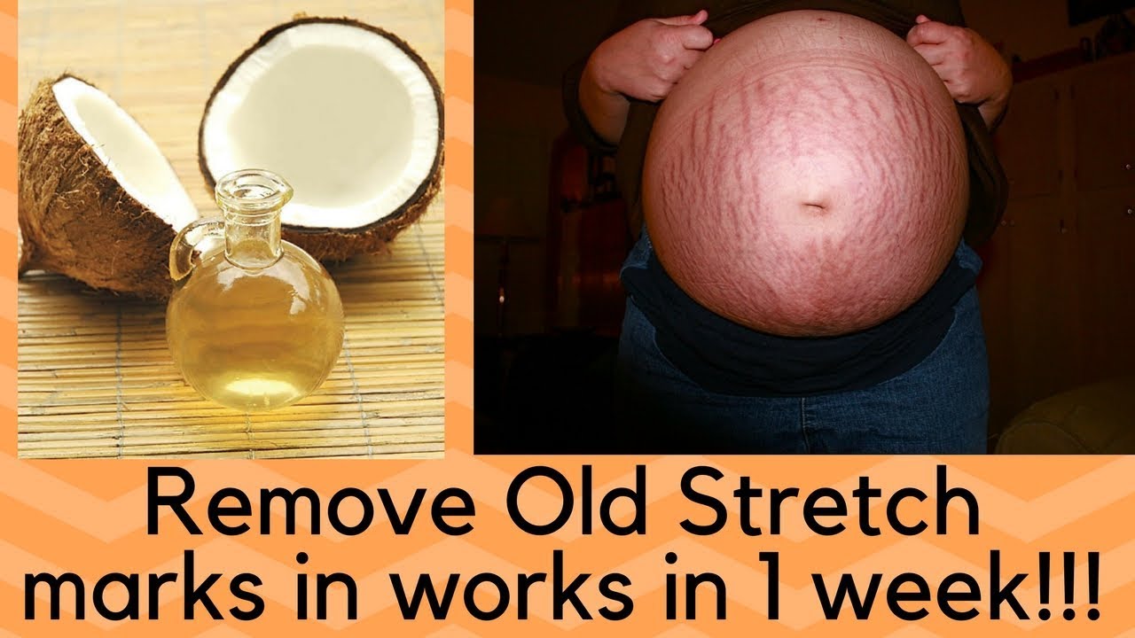 Video thumbnail for How To Remove Old Stretch Marks( FAST IN A WEEK!!!)