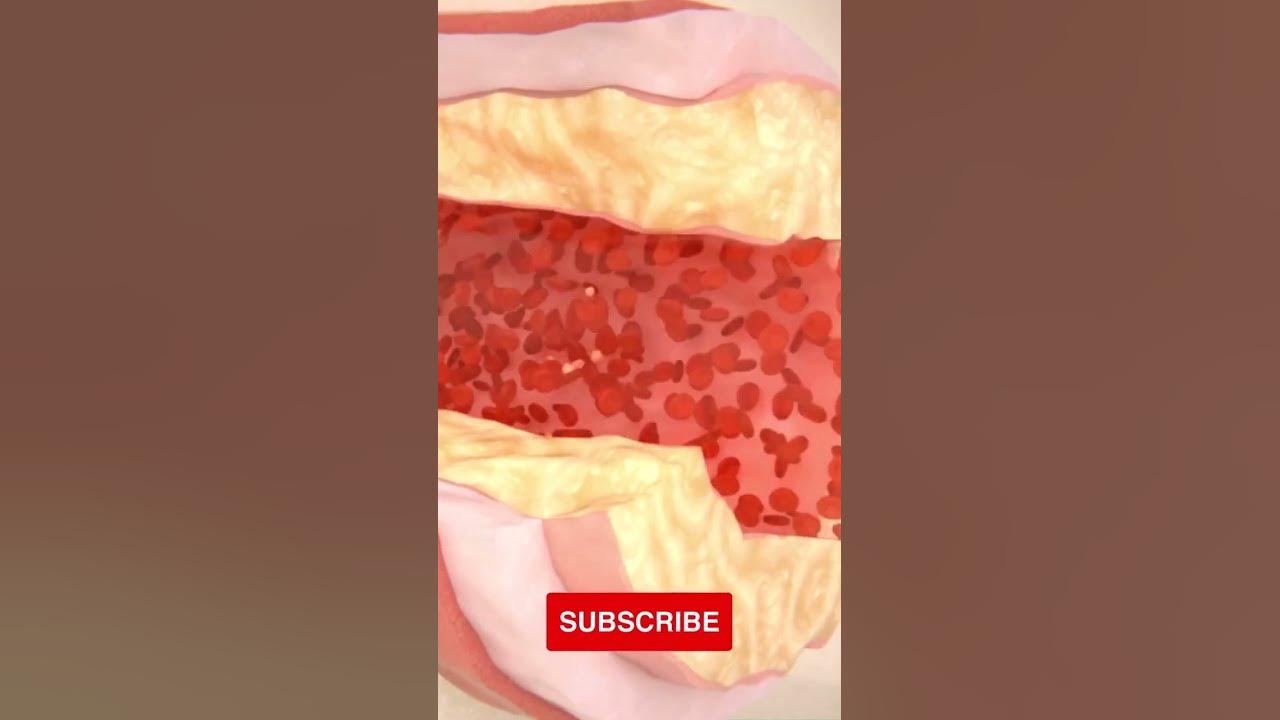 'Video thumbnail for What Is Coronary Artery Disease and How to Treat It? #shorts'