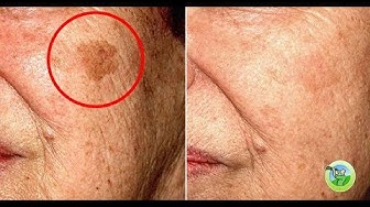 Video thumbnail for 5 Home Remedies to Remove Any Type of Skin Spot from Your Face