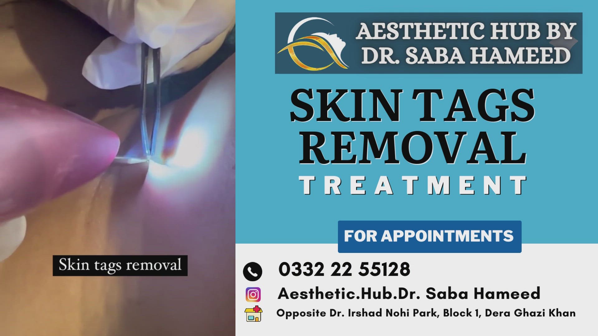Video thumbnail for Skin Tag Removal