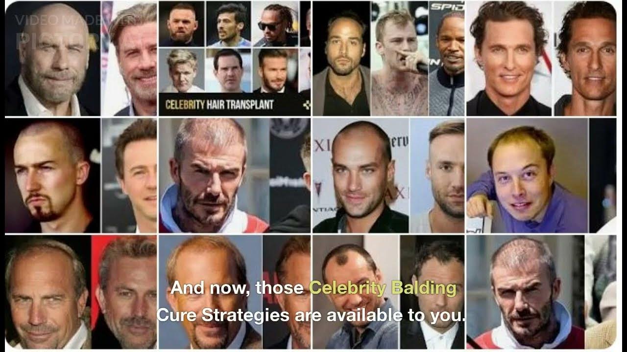 Video thumbnail for Balding Celebrity With Hair Transplants: Reveals Hollywood hair loss Secret