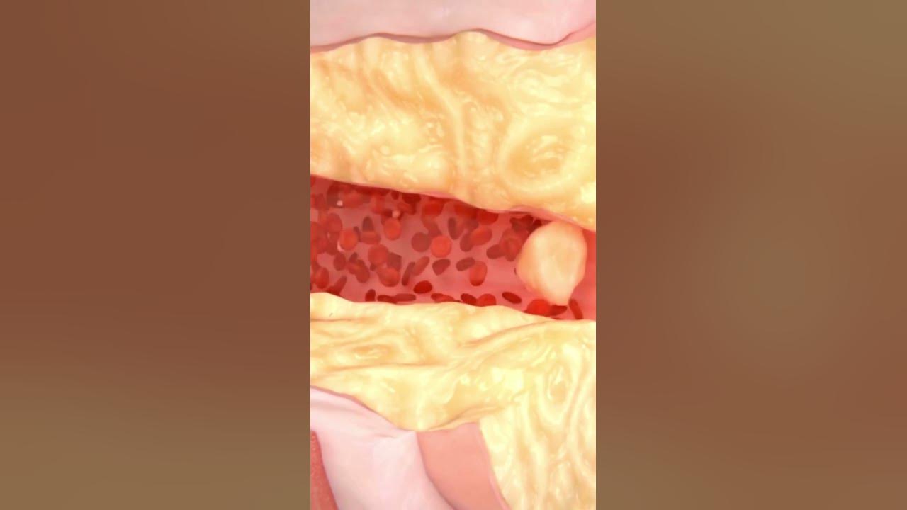 'Video thumbnail for Apple a Day Keeps the Clogged Arteries Away #shorts'
