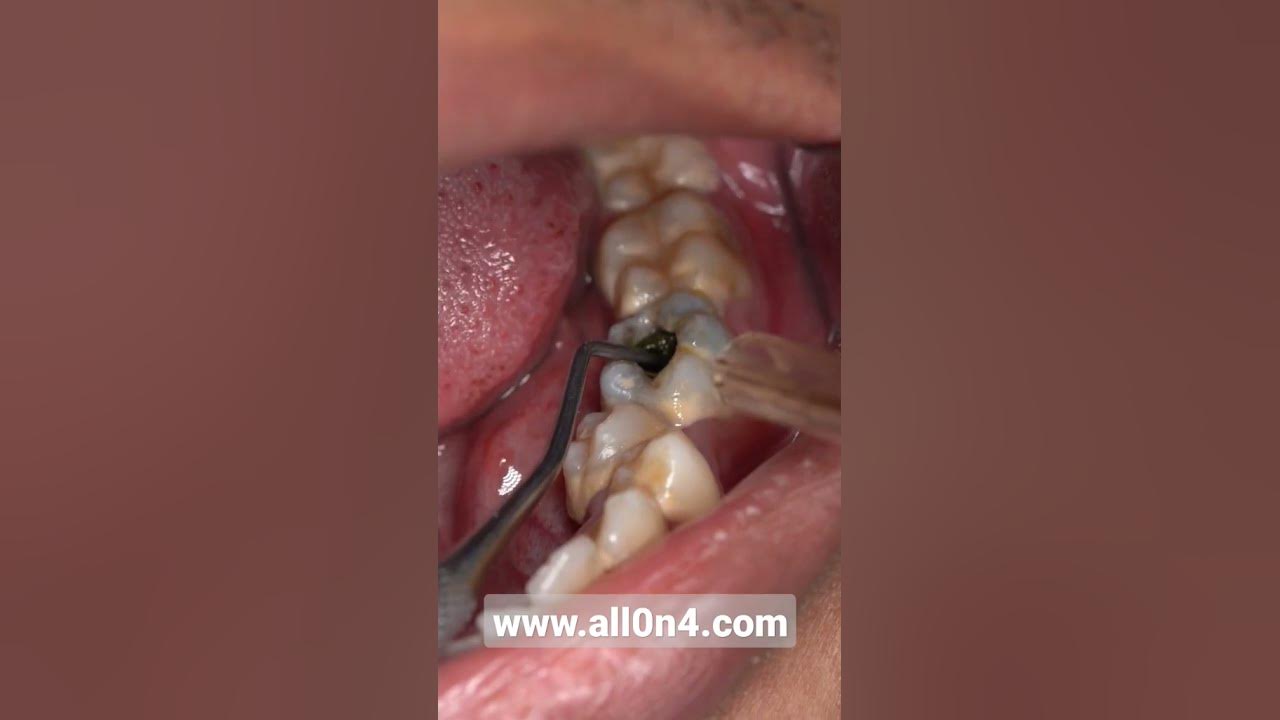 'Video thumbnail for #dental #cleaning #shorts 😱😁#braces #veneers  #scaling #doktergigi #dentist #satisfyingvideos'