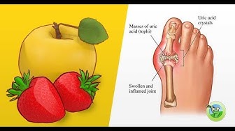 Video thumbnail for Top 7 Fruits That Help Lower Uric Acid Levels And Prevent Gout