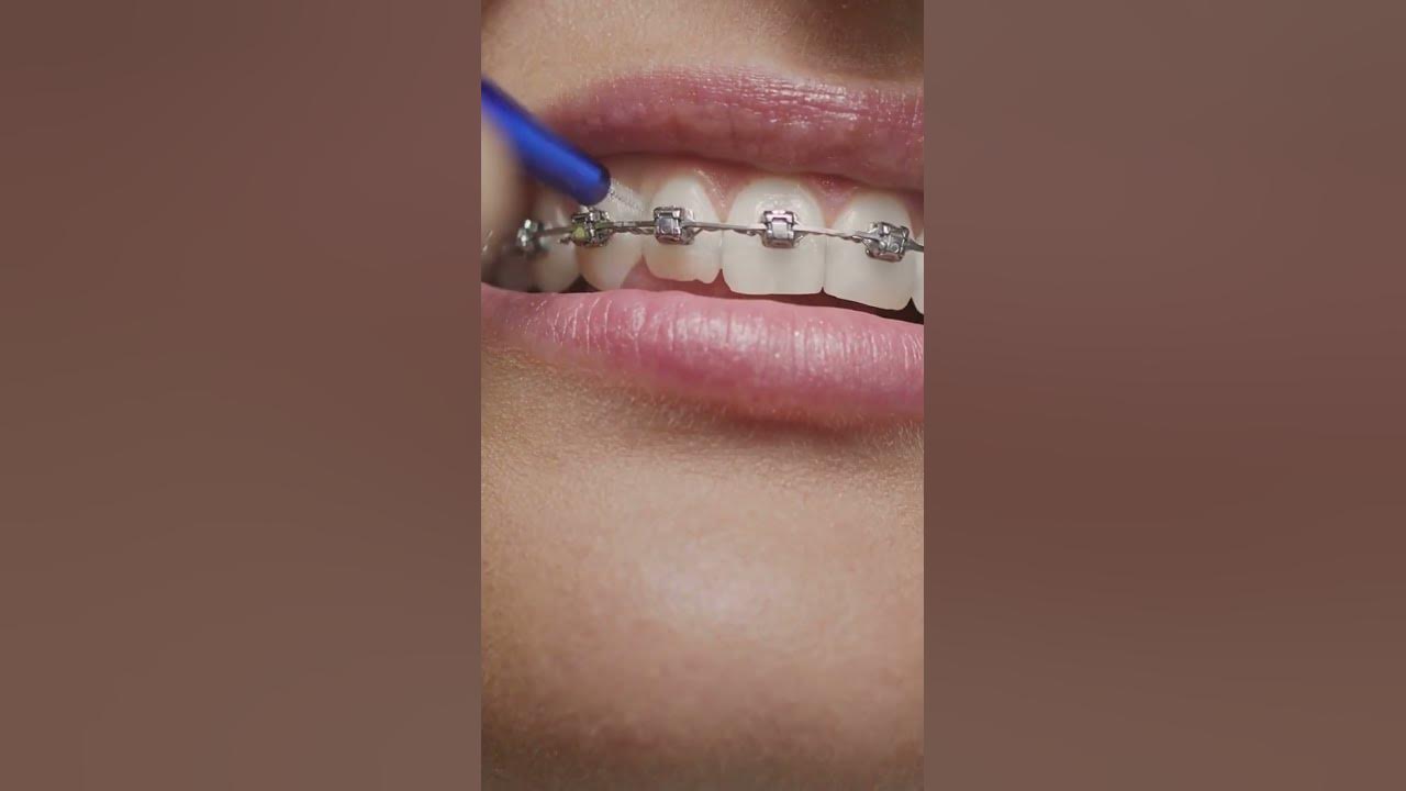'Video thumbnail for Do You Have Buck Teeth? You're Not Alone #shorts'