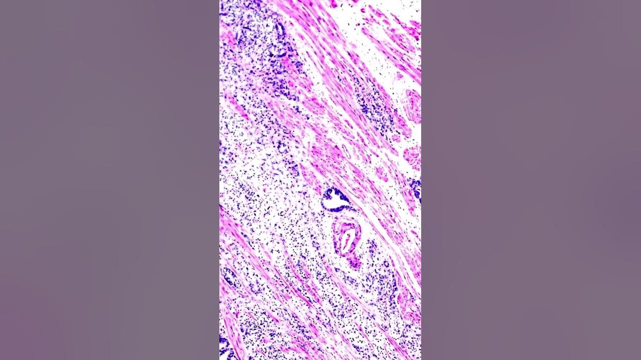 'Video thumbnail for How Is Breast Cancer Diagnosed? From Lumps to Chemotherapy #shorts'