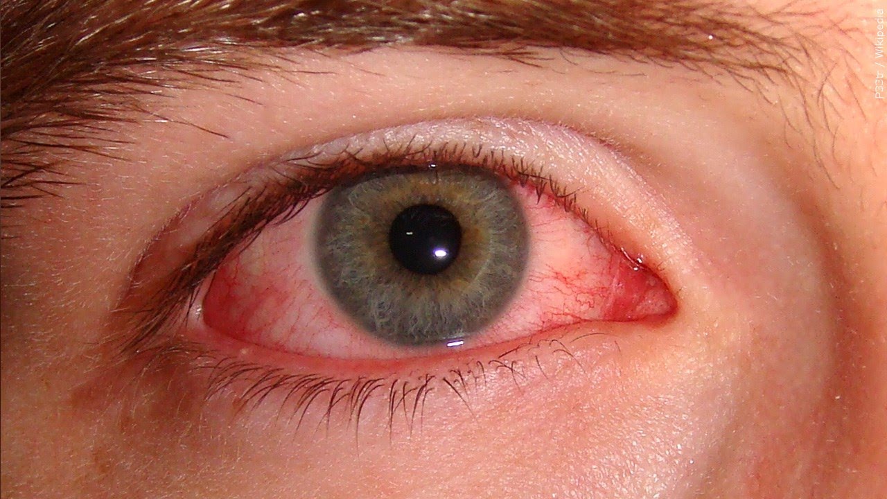 Video thumbnail for COVID 19 and Pink Eye