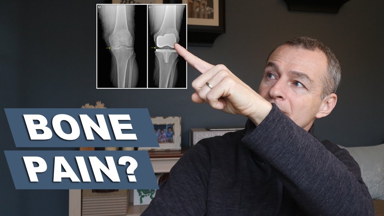 Video thumbnail for Why do I have bone pain after knee replacement surgery | First 12 weeks