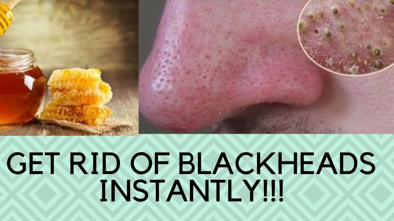 Video thumbnail for How To Get Rid Of Blackheads Naturally Overnight -Get rid of blackheads and clogged pores overnight