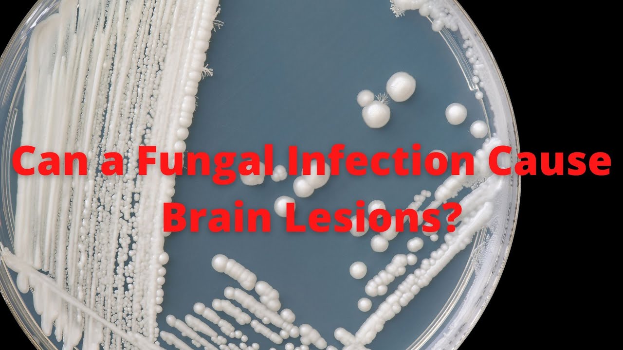 'Video thumbnail for Can A Fungal Infection Cause Brain Lesions'