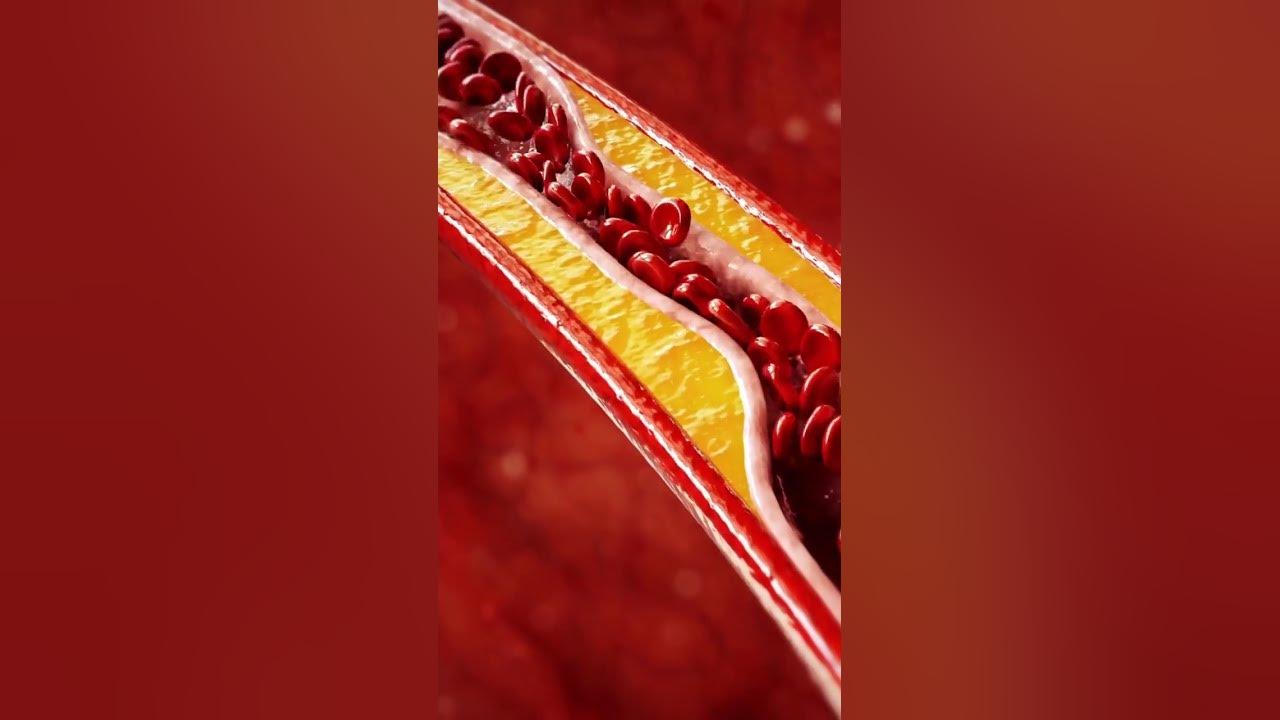 'Video thumbnail for A Stroke of Bad Luck: What Causes this Neurological Disaster #shorts'