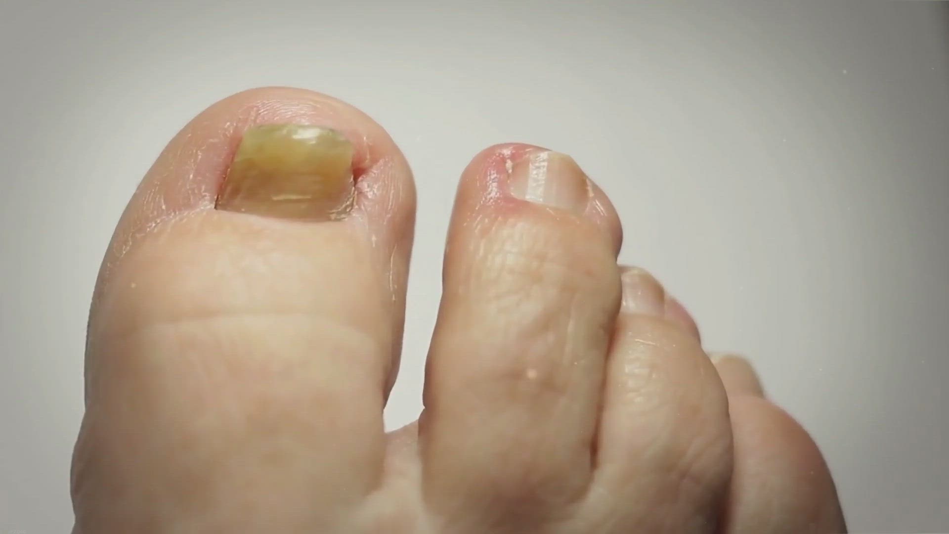 video of: Haz desaparecer fácilmente los hongos de los pies, cabeza, manos y uñas