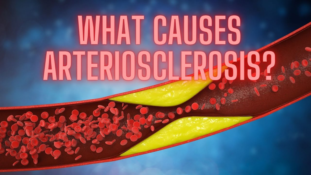 'Video thumbnail for What Causes Arteriosclerosis?'