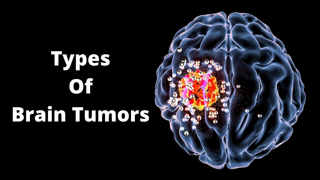 'Video thumbnail for What Are the Main Types of Brain Tumors'