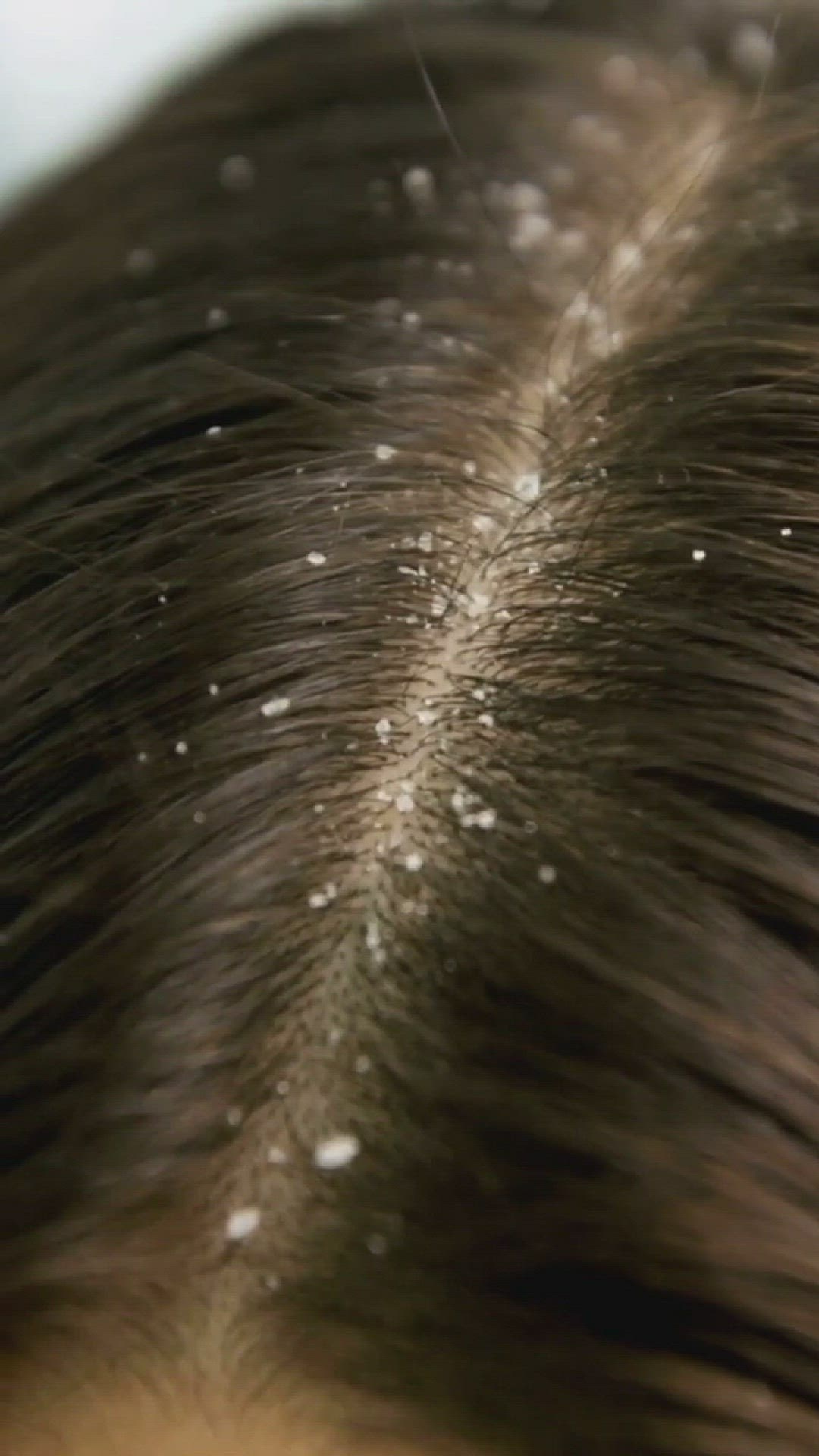 'Video thumbnail for Dandruff: The Flaky Truth #shorts'
