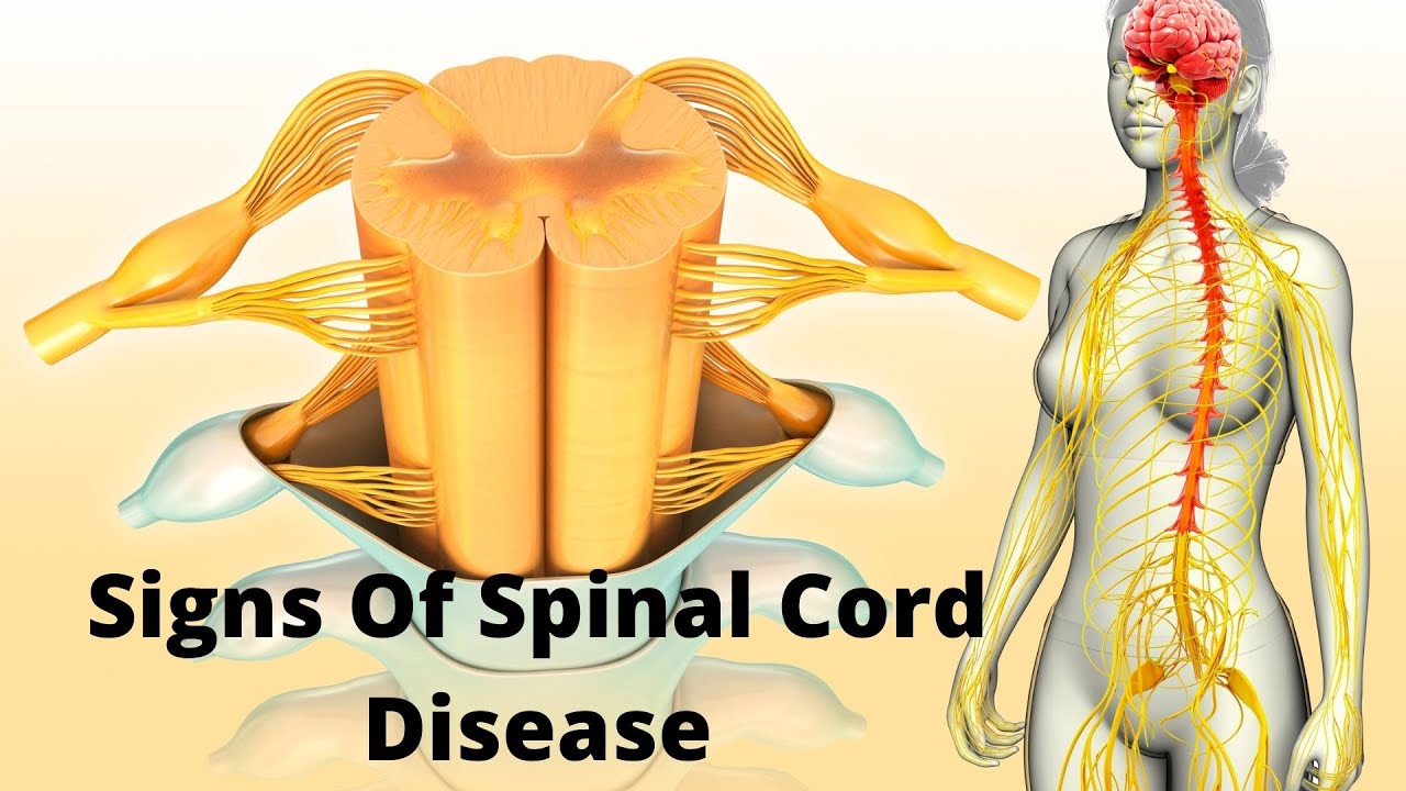 'Video thumbnail for 10 Signs you may have a spinal cord disease'