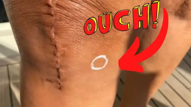 'Video thumbnail for Pain on the Inside Edge of Knee After Total Knee Replacement'
