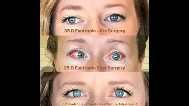 'Video thumbnail for What to Expect with Strabismus Surgery Suture Adjustments.  Yes, It's the WORST!'