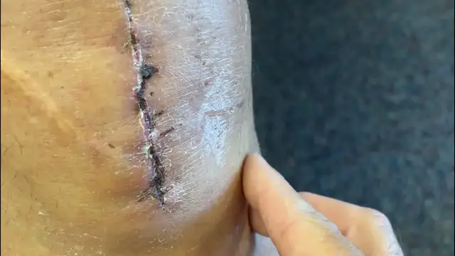 'Video thumbnail for Follow Up Physical Therapy After Total Knee Replacement 10 Days After Surgery #TKRevision'