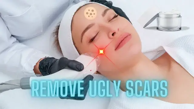 'Video thumbnail for 5 way to remove ugly scars'