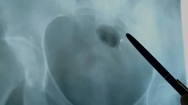 'Video thumbnail for 10 Warning Signs You May Have Kidney Stones – Don’t Ignore These!'