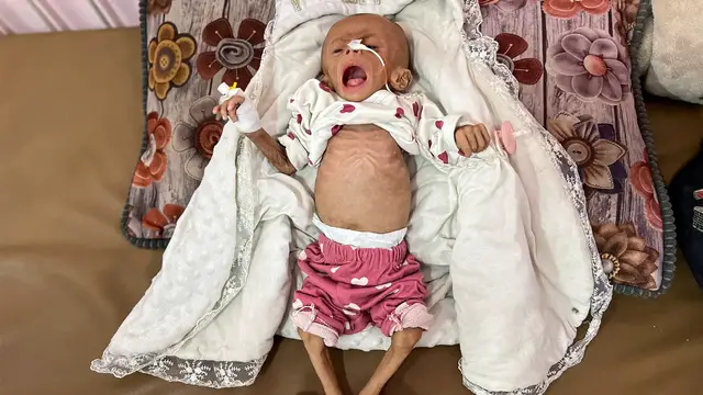 'Video thumbnail for UN agency sounds alarm as 1 in 10 children in Gaza now malnourished'