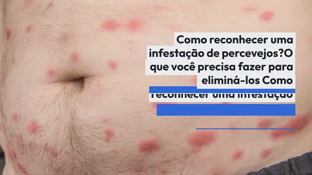 'Video thumbnail for Como reconhecer uma infestação de percevejos? O que você precisa fazer para eliminá-los'