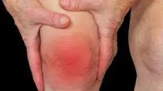 'Video thumbnail for Osteoarthritis Treatment Join Pain'