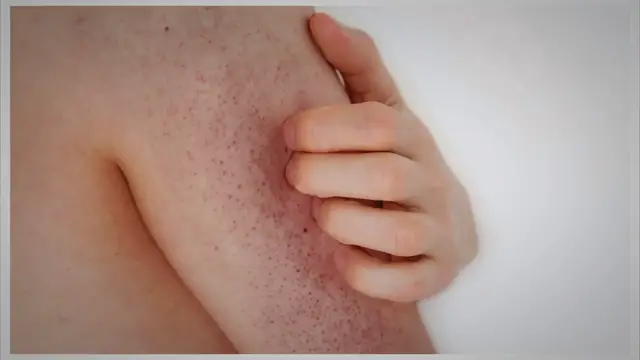 'Video thumbnail for Kératose Pilaire : 15 Remèdes Naturels Efficaces pour Atténuer les Boutons'