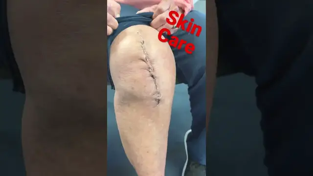 'Video thumbnail for Knee Replacement Skin Care'
