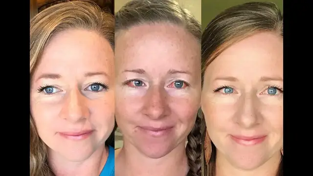 'Video thumbnail for What To Expect With Adult Strabismus Surgery'