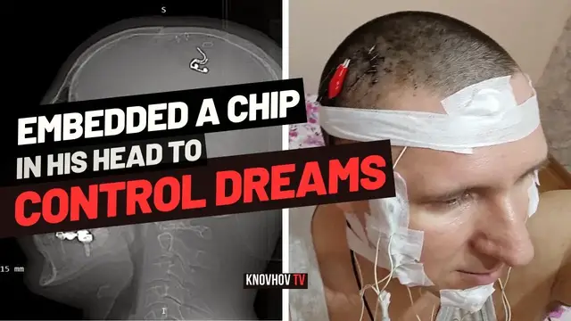 'Video thumbnail for Man Embedded a Chip in his Head to Control Lucid Dreams'