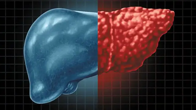 'Video thumbnail for 6 Warning Signs Your Liver Might Be FAILING!'