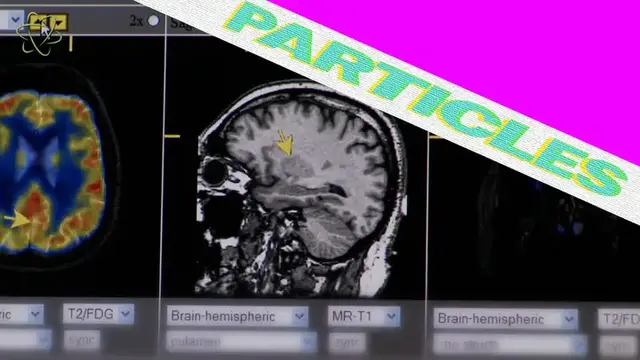 'Video thumbnail for Brain Shrinkage Linked To COVID-19'