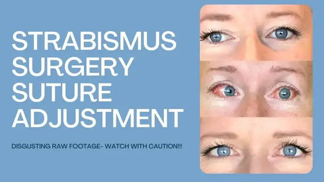 'Video thumbnail for Raw Footage of Strabismus Surgery Suture Adjustment Appointment'