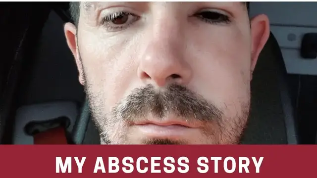 'Video thumbnail for Abscess | cyst | abscess tooth'